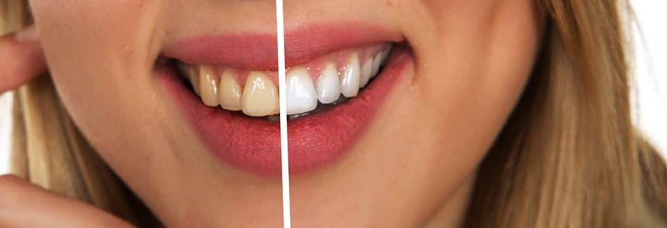 patient smile before and after